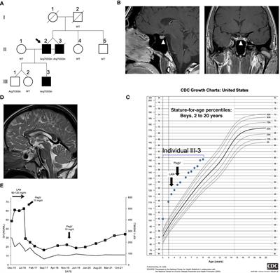 Germline loss-of-function PAM variants are enriched in subjects with pituitary hypersecretion